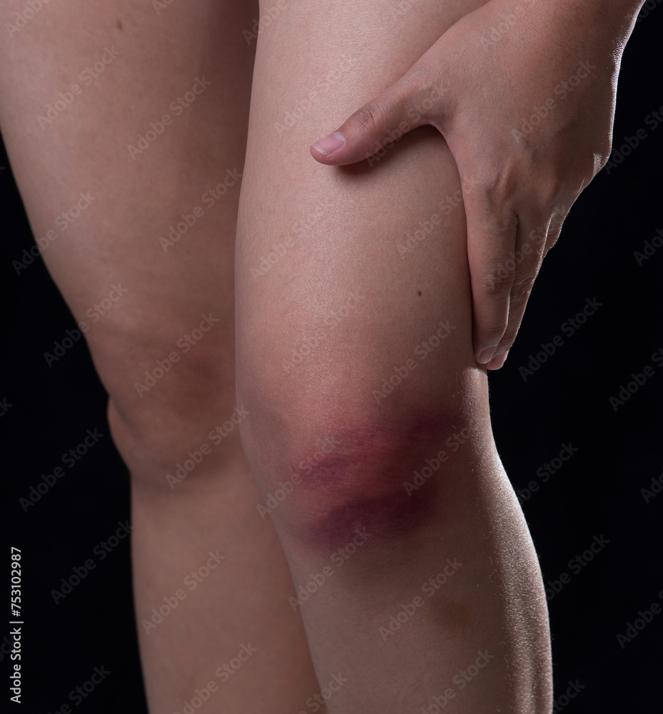 Bruises from blood on woman knee. Injection bruises. Bruises from blood on woman knee. Injection bruises.