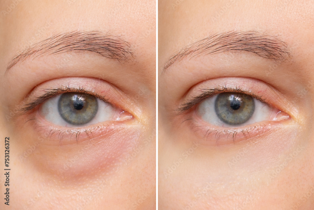 Close-up of the face of a young woman with a bag under her eye before and after treatment. Swelling of the lower eyelid. Removing bruises and dark circles using cosmetics and creams. Blepharoplasty - obrazy, fototapety, plakaty 