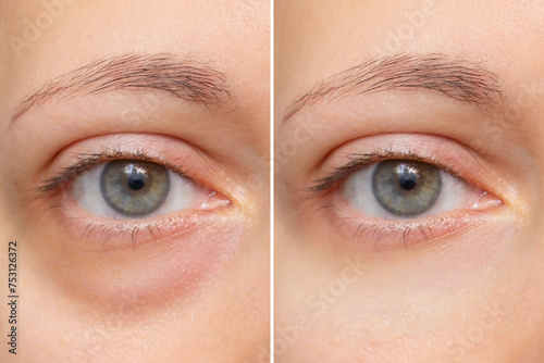 Close-up of the face of a young woman with a bag under her eye before and after treatment. Swelling of the lower eyelid. Removing bruises and dark circles using cosmetics and creams. Blepharoplasty photo