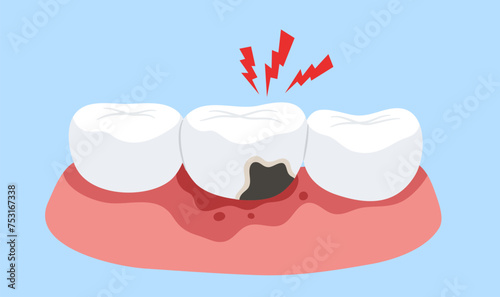 Tooth decay with pain on red pain gum. Concept of tooth cavity, toothache, dental care, dentistry, oral health, dentist, mouth, tooth caries. Flat vector illustration. 