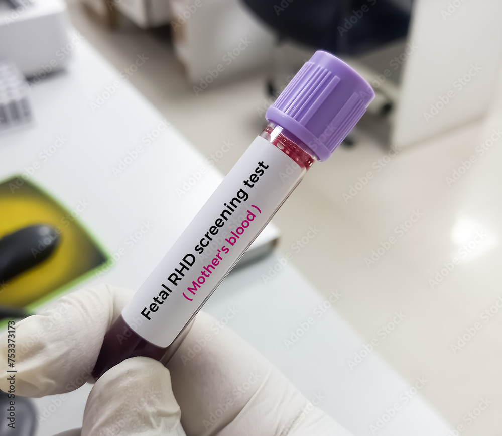 Blood sample for Fetal RHD Screening test for pregnant women. Down syndrome. Disorder of the chromosomes.