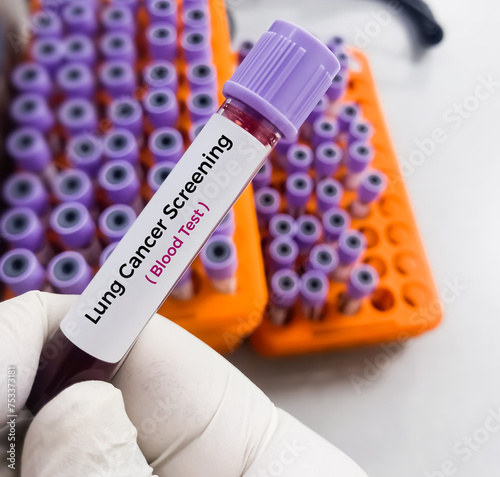 Blood sample for Fetal RHD Screening test for pregnant women. Down syndrome. Disorder of the chromosomes. photo