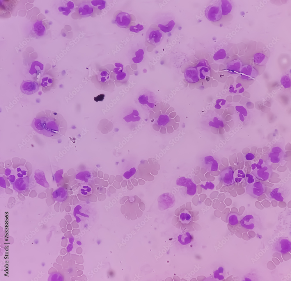 Leukemia. Photomicrograph of hematological blood slide showing neutrophilic leukocytosis with monocytosis with occasional myelocytes seen. Chronic myelomonocytic leukemia. Thrombocytopenia. Leukemia. Photomicrograph of hematological blood slide showing neutrophilic leukocytosis with monocytosis with occasional myelocytes seen. Chronic myelomonocytic leukemia. Thrombocytopenia.
