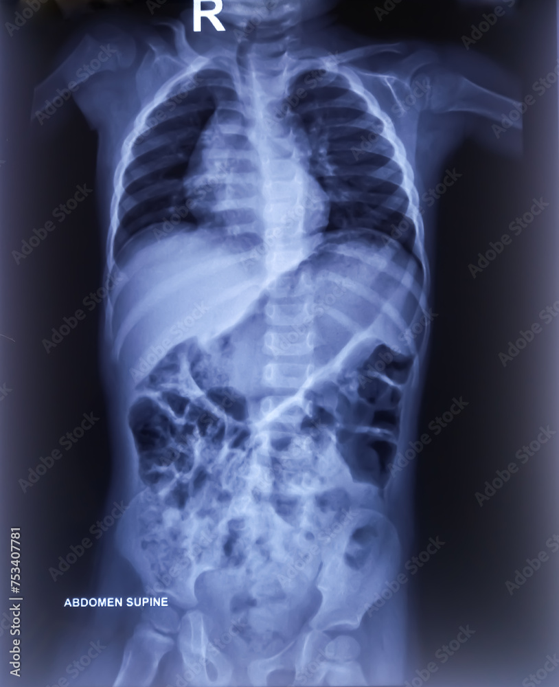 X-ray of Abdumen. Large bowel loops are distended with gas and loaded with faecal matters. X-ray of Abdumen. Large bowel loops are distended with gas and loaded with faecal matters.