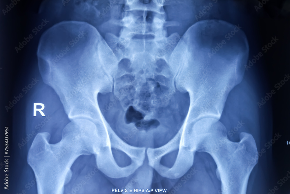 Pelvis xray. Film Xray of Pelvis, hip and SI joint are normal, Normal