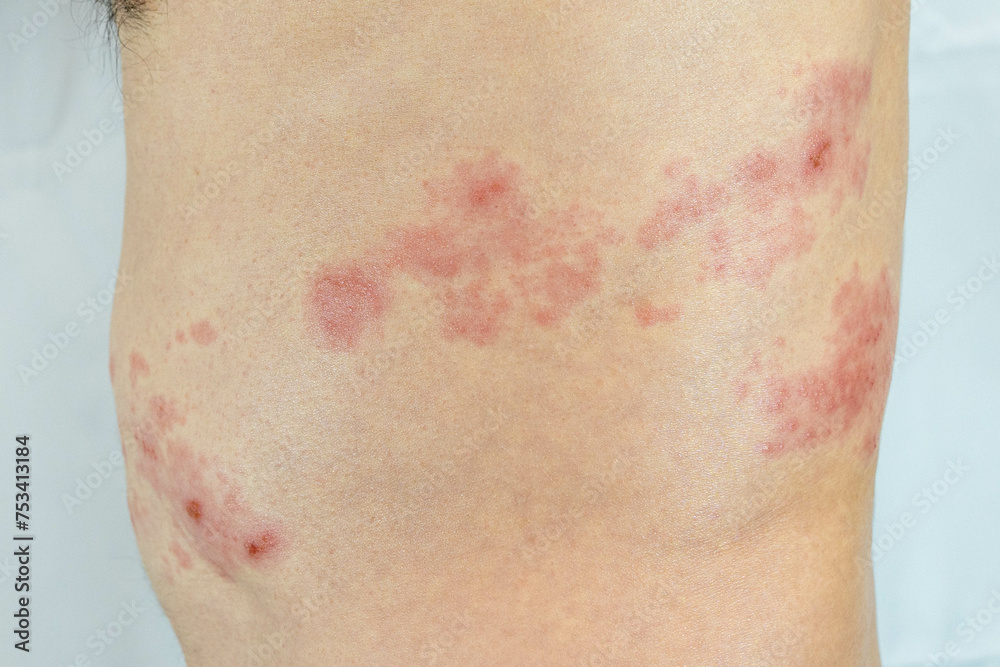 Fototapeta premium 胴体の左側に帯状疱疹を発症した男性の画像