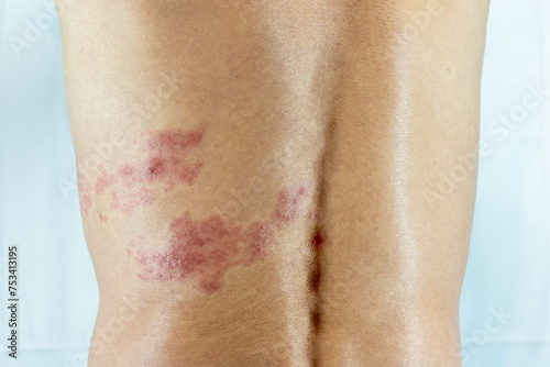 胴体の左側に帯状疱疹を発症した男性の画像
 photo