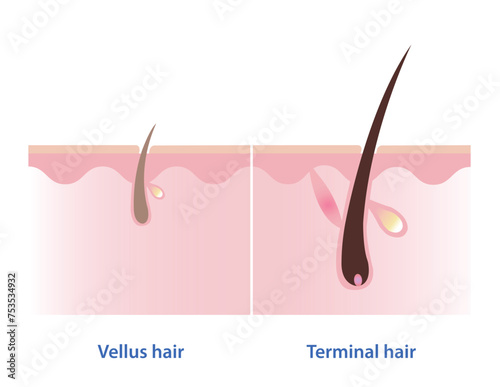 The difference between vellus hair and terminal hair vector on white background. Hair Types. Vellus hair is fine, wispy and generally unpigmented hair. Terminal hair is thick, long and pigmented hair. photo