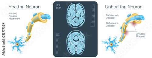 Brain MRI scan vector illustration. Magnetic resonance imaging is a medical imaging technique used in radiology to form pictures of the anatomy and the physiological processes inside the mind.  photo