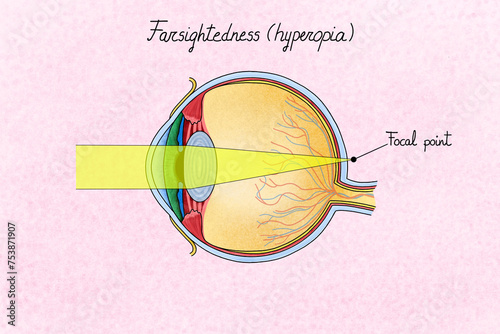 Human eye with farsightedness (hyperopia). Illustration photo