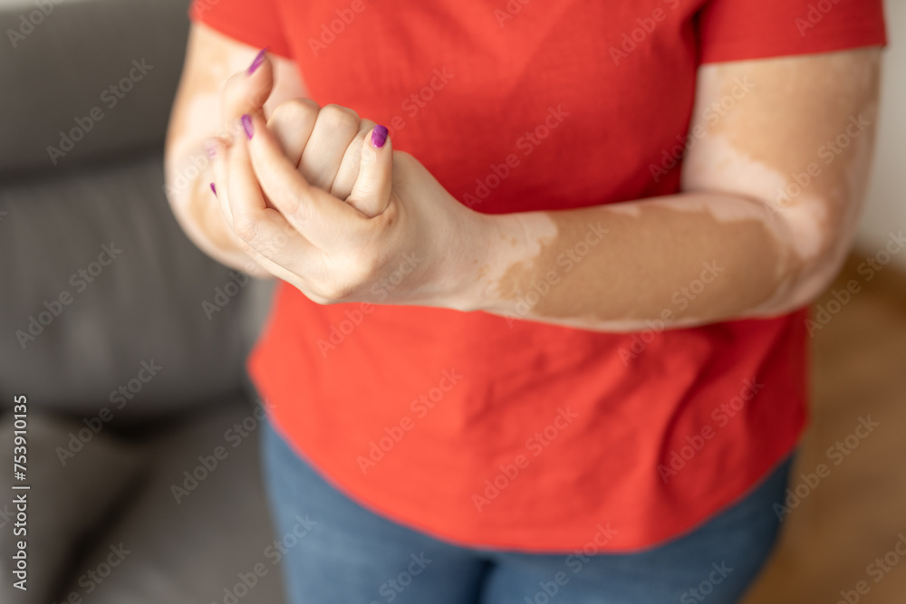 Hands of an anonymous woman with vitiligo using cream
