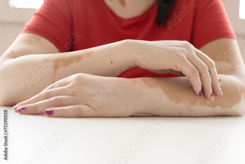 Portrait Of An Anonymous Girl With Vitiligo Skin photo