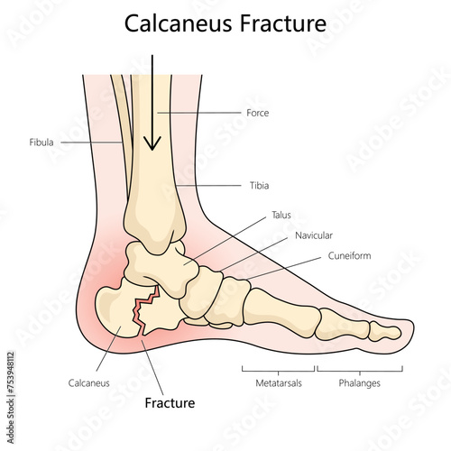 Calcaneus fracture structure diagram hand drawn schematic vector illustration. Medical science educational illustration