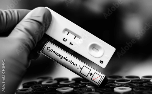 Blood sample of patient positive tested for cytomegalovirus by rapid diagnostic test. photo