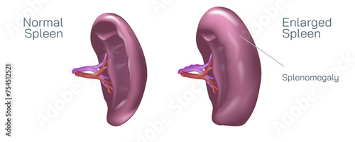 Your spleen is an organ that sits just below your left rib cage. Many conditions, including infections, liver disease and some cancers can cause an enlarged spleen vector illustration. photo