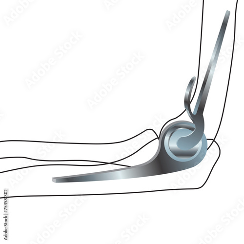 Endoprosthetics, elbow joint prosthesis. Vector illustration. Medical poster photo