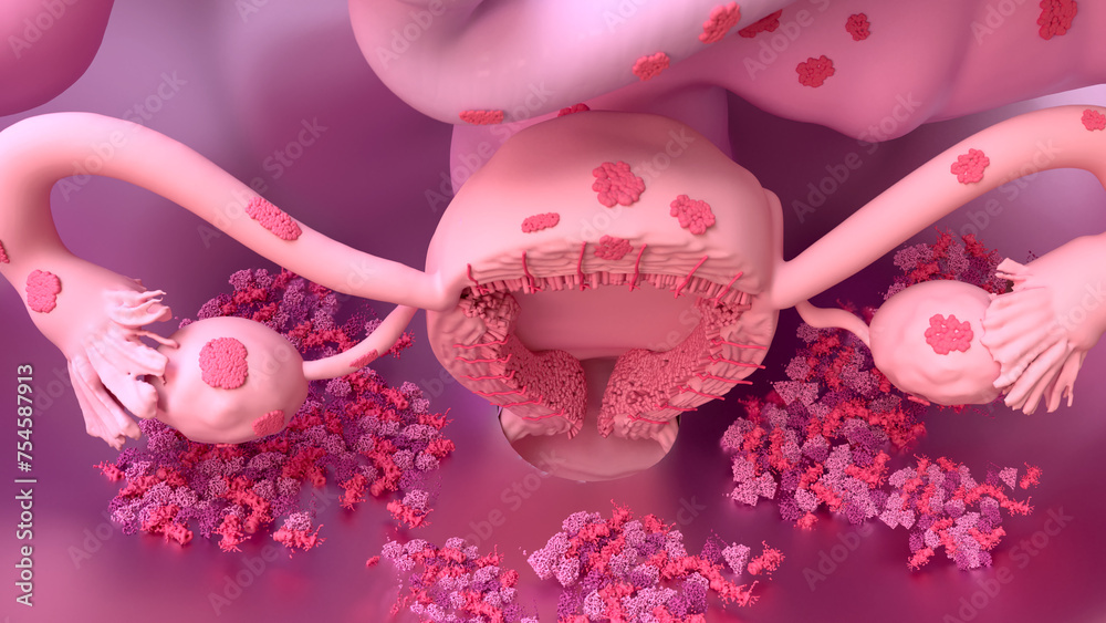 Endometriosis, disease of the female reproduction system - obrazy, fototapety, plakaty 