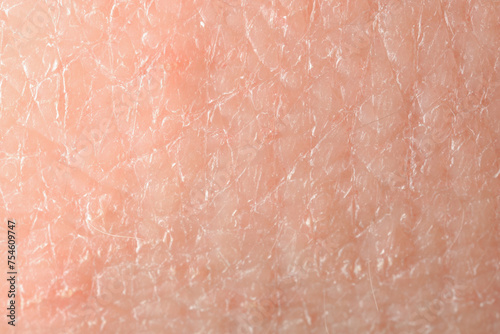 Texture of dry skin as background, macro view photo
