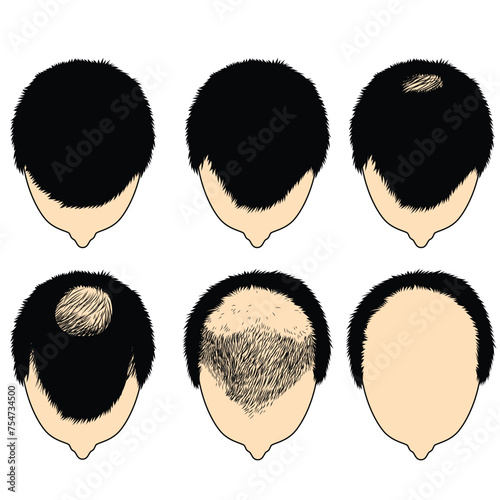 Set of Hair loss stages vector illustration. Alopecia male pattern baldness