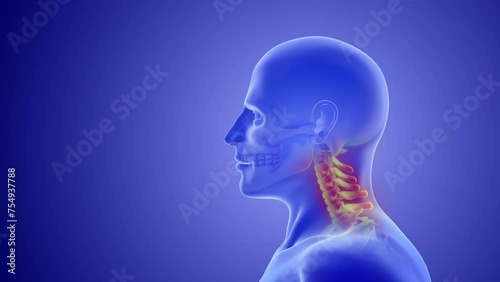 Whiplash mechanism in cervical spine or neck injuries
