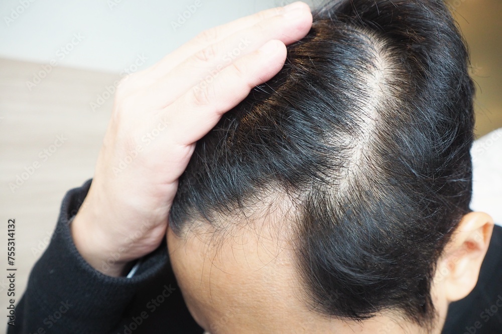 Young Asian man using his hand slicking his hair back after facing hair loss problem Taking medicine like zinc and biotin to make his hair grow faster and thicker Men health and medical concept Young Asian man using his hand slicking his hair back after facing hair loss problem Taking medicine like zinc and biotin to make his hair grow faster and thicker Men health and medical concept