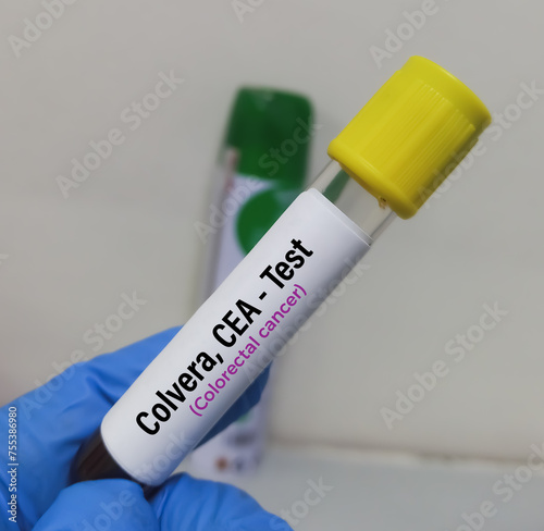 Blood sample for Colvera, CEA blood test to diagnosis of Bowel cancer, also known as colorectal cancer (CRC). photo