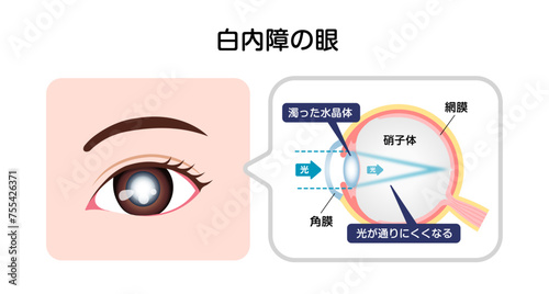 白内障の眼 構造と原因 ベクターイラスト