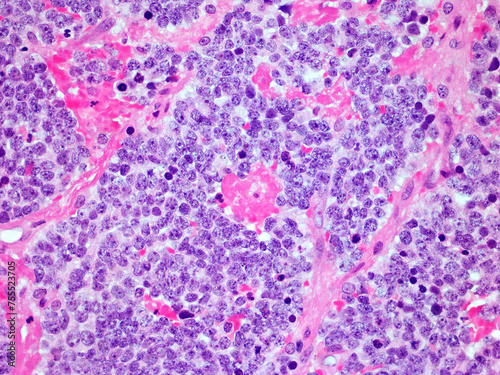 Microscopic Image of a Neuroblastoma Malignant Tumor of the Adrenal Gland Viewed at 300x Magnification with Hematoxylin and Eosin Staining. One of the most Common Cancers Affecting Children. photo