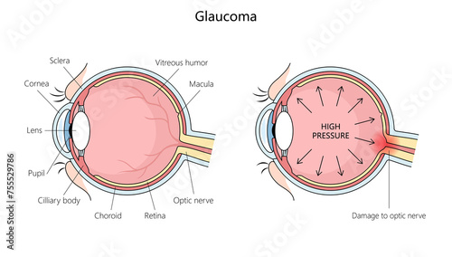 anatomy of a human eye with glaucoma, highlighting increased pressure and optic nerve damage structure diagram hand drawn schematic raster illustration. Medical science educational illustration photo
