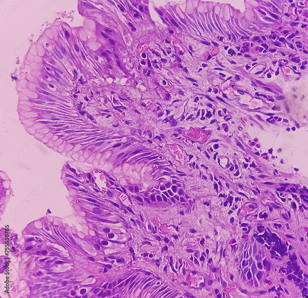 Tissue From Antrum Of Stomach Endoscopic Biopsy Chronic Nonspecific