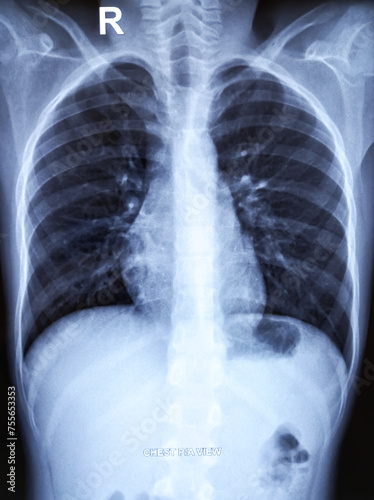 Chest xray PA view film. Pneumonia or pneumonitis. photo