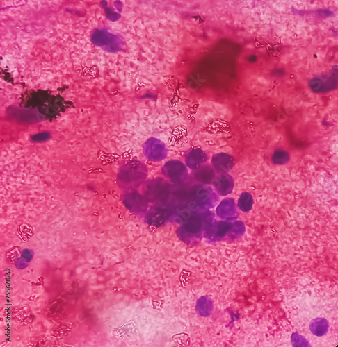 CT Guaided FNA cytology from left hilar mass. Microscopic show atypical small cells, malignant cells, inflammatory cells and blood background. Small cell carcinoma. photo