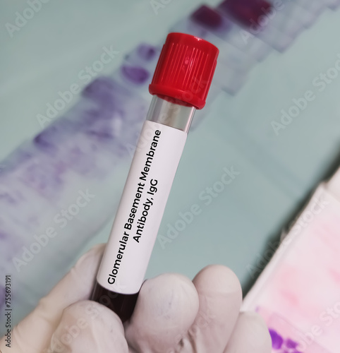 Blood sample for Glomerular Basement Membrane Antibody or GBM IgG test to diagnosis of asture’s Syndrome (Anti-GBM disease). photo