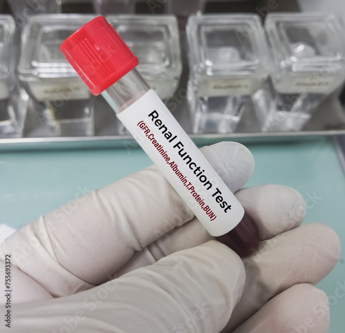 Canvas Print Blood sample for Renal Function test (Creatinine, BUN, eGFR, albumin, total protein, creatinine clearance) for diagnosis of renal or kidney disease