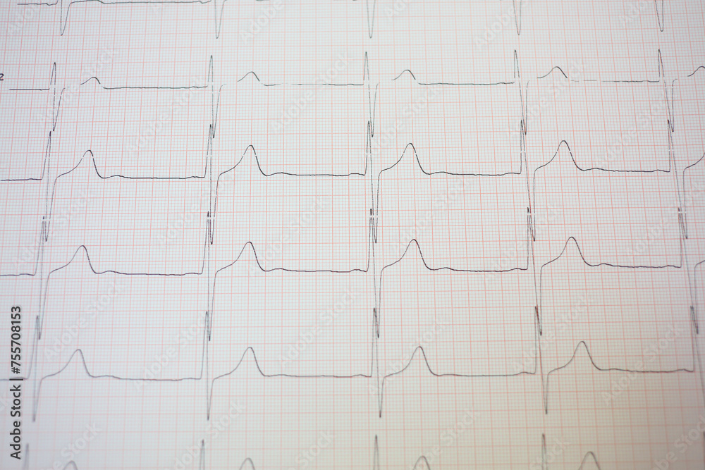 Electrocardiogram in pink paper form in hospital, close up view