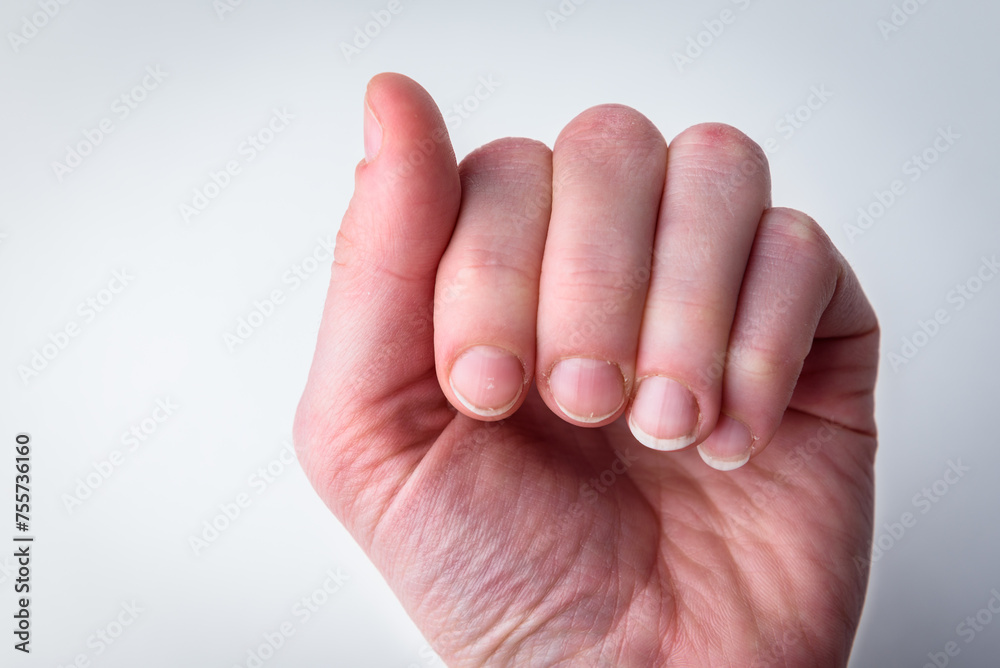 Woman's hand with damaged and brittle nails after doing manicure on gray background. Woman's hand with damaged and brittle nails after doing manicure on gray background.