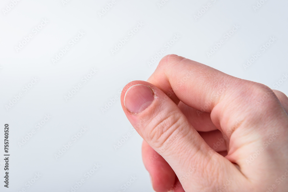 Damaged and brittle nails after doing manicure on gray background. Damaged and brittle nails after doing manicure on gray background.