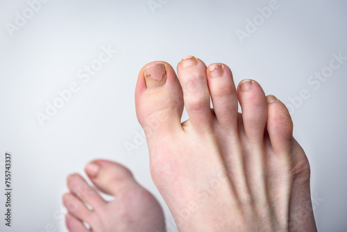 Feet with damaged and unkempt toenails on gray background.