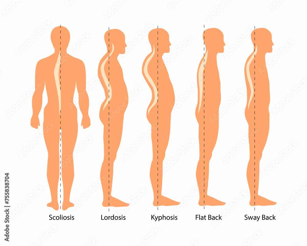 Medical illustration of spinal deformity types: scoliosis, lordosis and ...