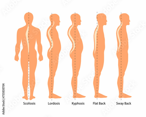 Fotografija Medical illustration of spinal deformity types: scoliosis, lordosis and kyphosis, Sway back
