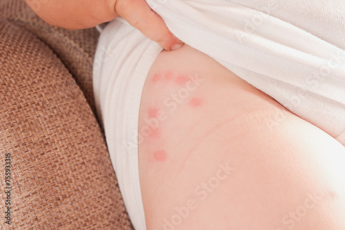 Toddler touches her leg after being bitten by mosquito or bedbug, suffering from allergic reaction and swelling, experiencing pain, sits on bed at home. Skin reaction to blood-sucking insects. Allergy