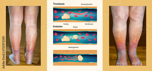 Deep Vein Thrombosis or Blood Clots. Embolus. photo