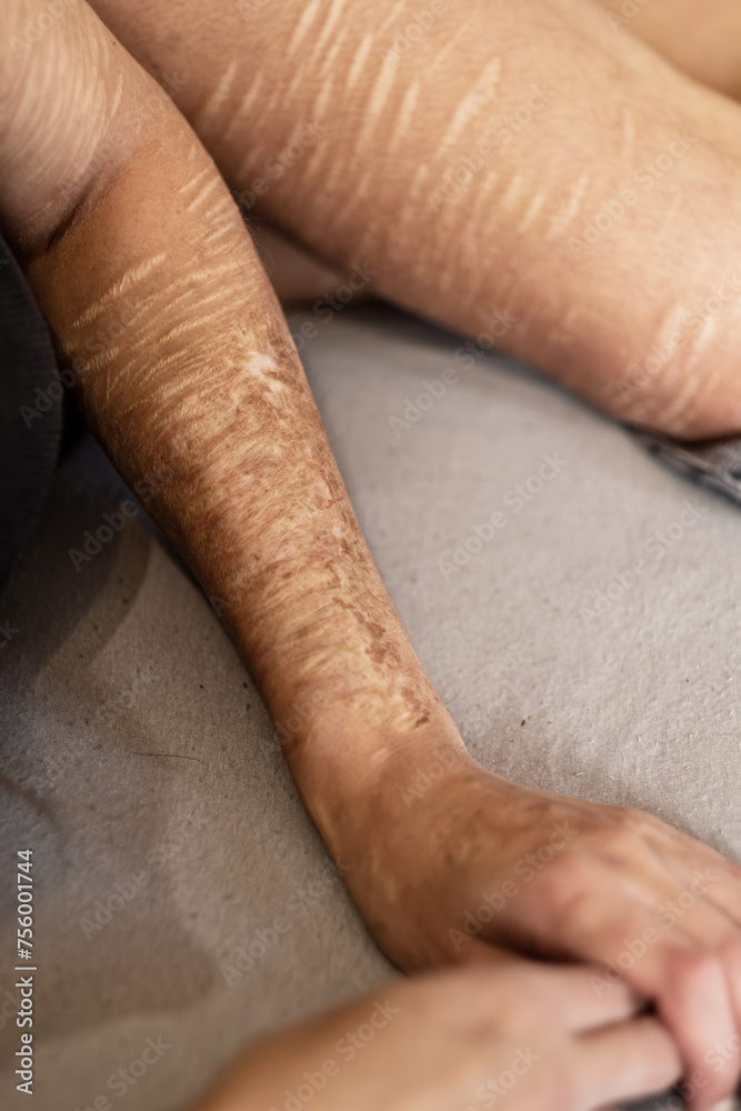 Fototapeta premium arm and leg of a Woman with heavy Cuts and scars of self-mutilation in frustration, self-abusing