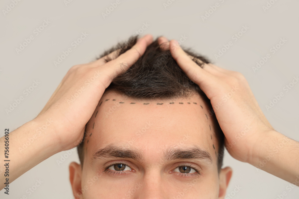 Young man with hair loss problem and marked forehead on light background, closeup Young man with hair loss problem and marked forehead on light background, closeup