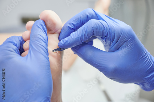podiatrist hands with blue gloves operating on callous hyperkeratosis in his podiatry clinic. Holds a patient's foot while using the scalpel to eliminate discomfort when walking. photo