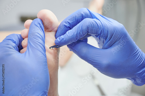 podiatrist hands with blue gloves operating on callous hyperkeratosis in his podiatry clinic. Holds a patient's foot while using the scalpel to eliminate discomfort when walking.