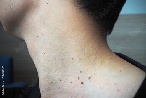 Many skin tags or Acrochordon on the neck They are small soft and common benign on the human skin especially on adult skin and can be irritated by shaving and daily clothing photo