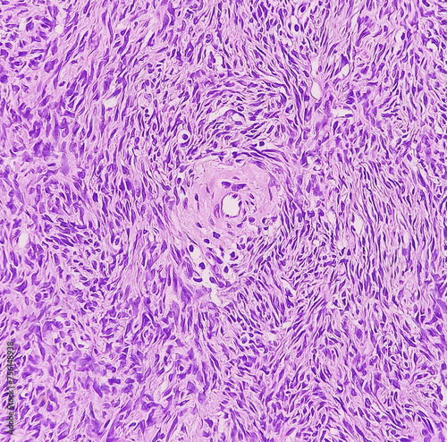 Photo of benign brenner tumor of ovary  showing tumor sheet on the right side and ovarian stroma on the right side.