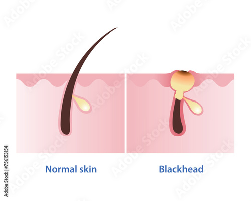 Normal skin and blackhead acne vector illustration isolated on white background. Blackhead, type of non inflammatory pimple. Open comedone. Skin care and beauty concept.