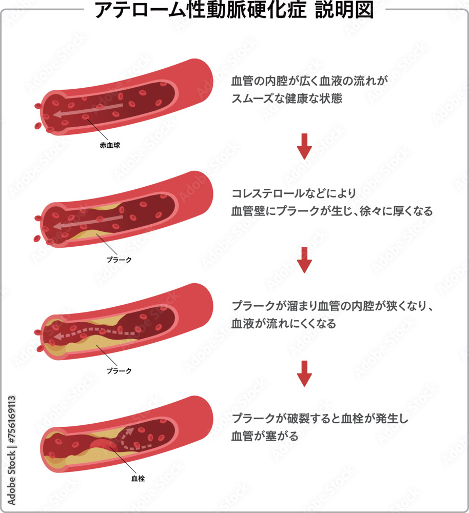 Vecteur Stock 血管の流れと動脈硬化の説明図 医療イラスト | Adobe Stock